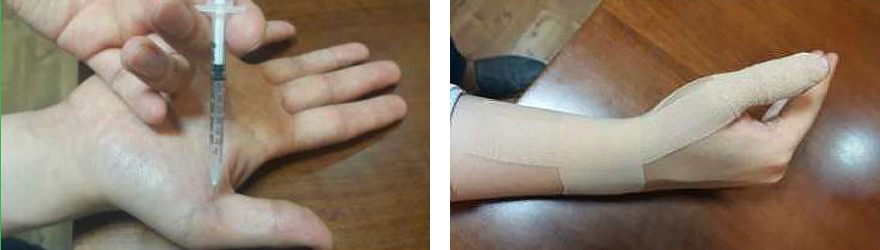 (좌)신바로약침 치료 / (우)테이핑 치료 | 자생의료재단